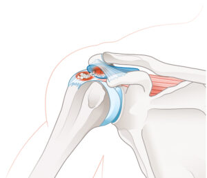 cum să inserați o articulație pe genunchi dureri articulare de ciclu mediu